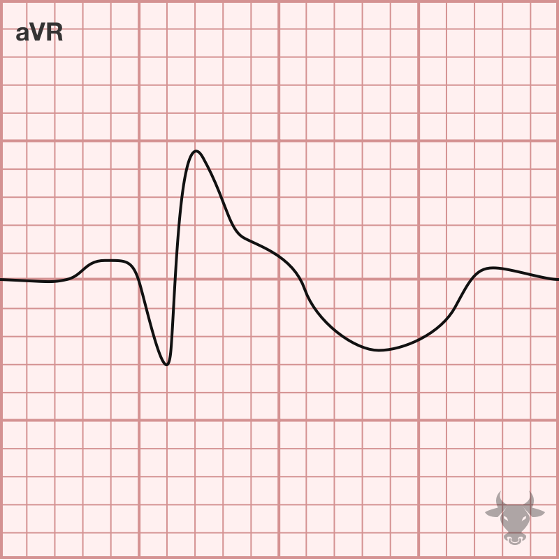 Sodium Channel Toxicity