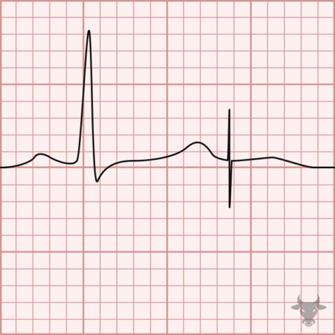 Pacemaker Malfunction Ecg Stampede Pacemaker Malfunction Ecg Stampede