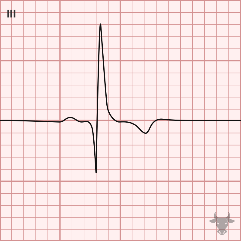 Pulmonary Embolism