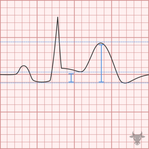 Acute Pericarditis | ECG Stampede