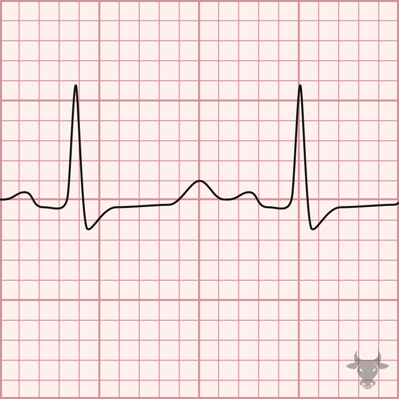 Hypocalcemia ECG Stampede