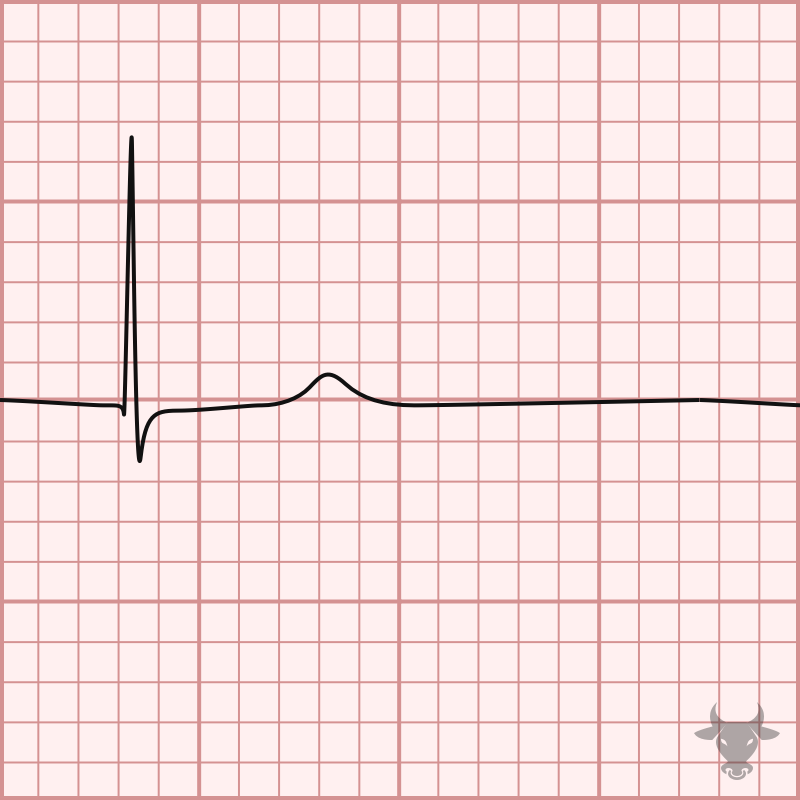 Sinus Node Dysfunction