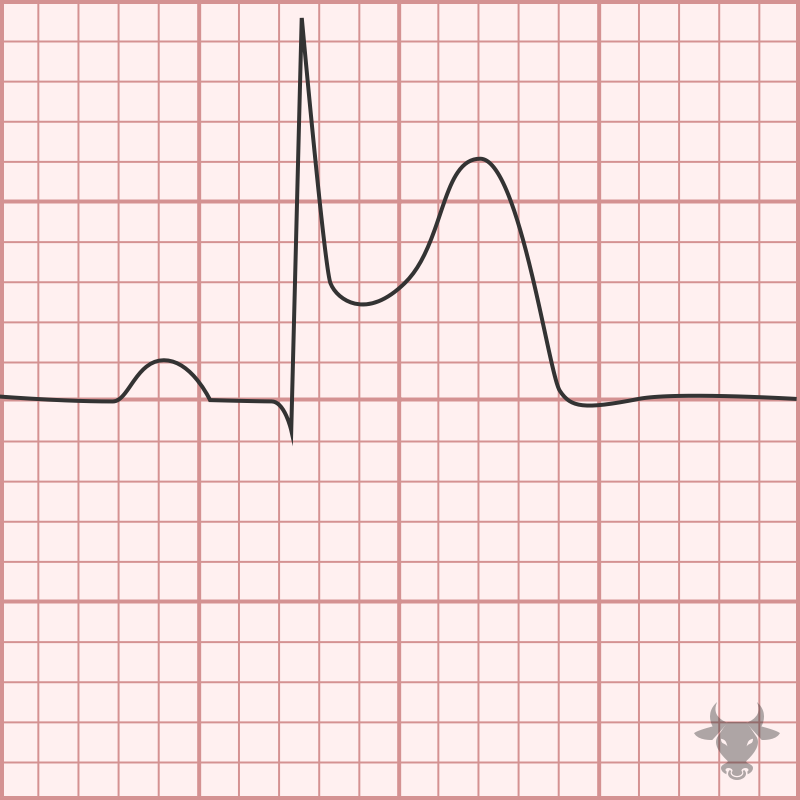 Inferior STEMI. There is > 1mm of ST elevation in leads II, III and