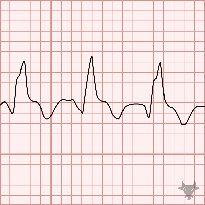 Supraventricular Tachycardia with Aberrancy