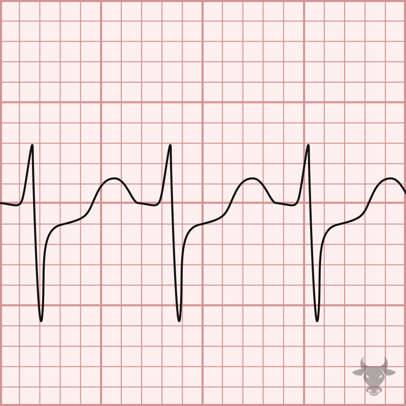 Supraventricular Tachycardia ECG Stampede Supraventricular Tachycardia ECG Stampede