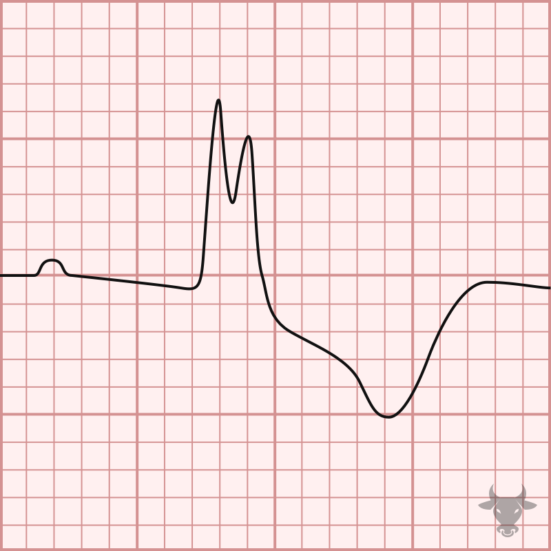 Trifascicular Block