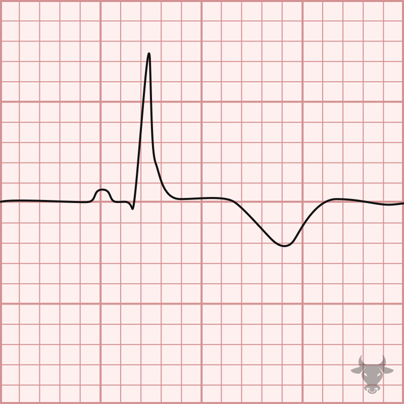 T-wave Inversions