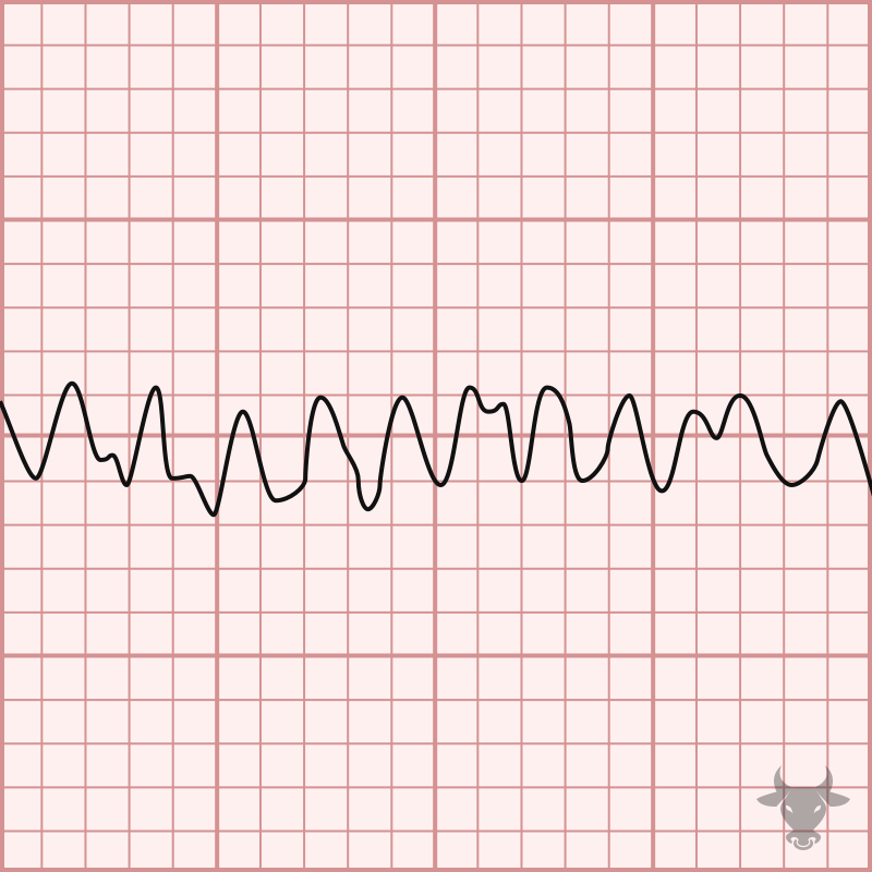 Ventricular Fibrillation