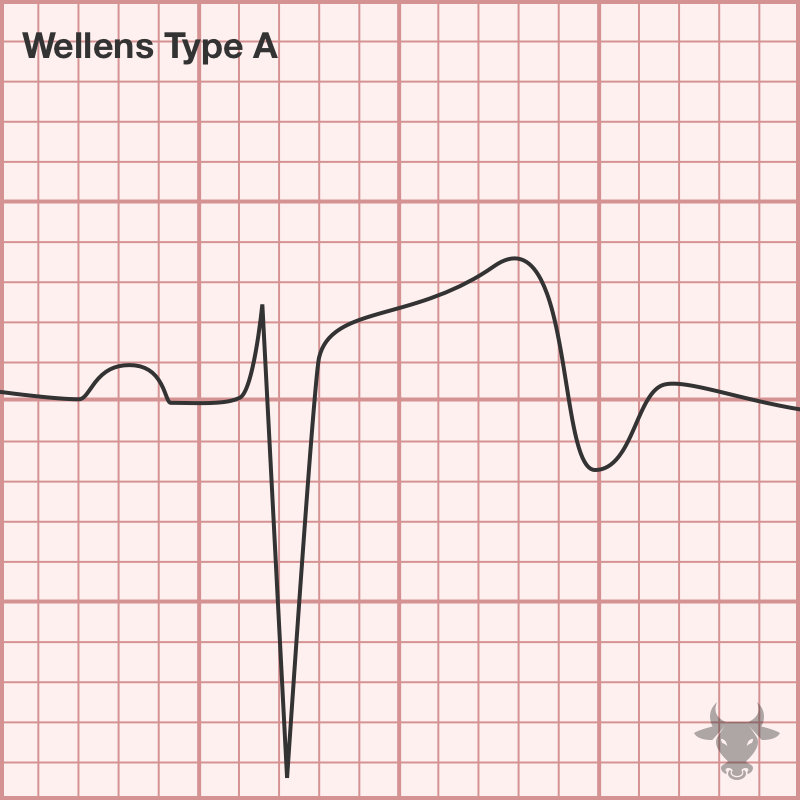 Wellens Syndrome