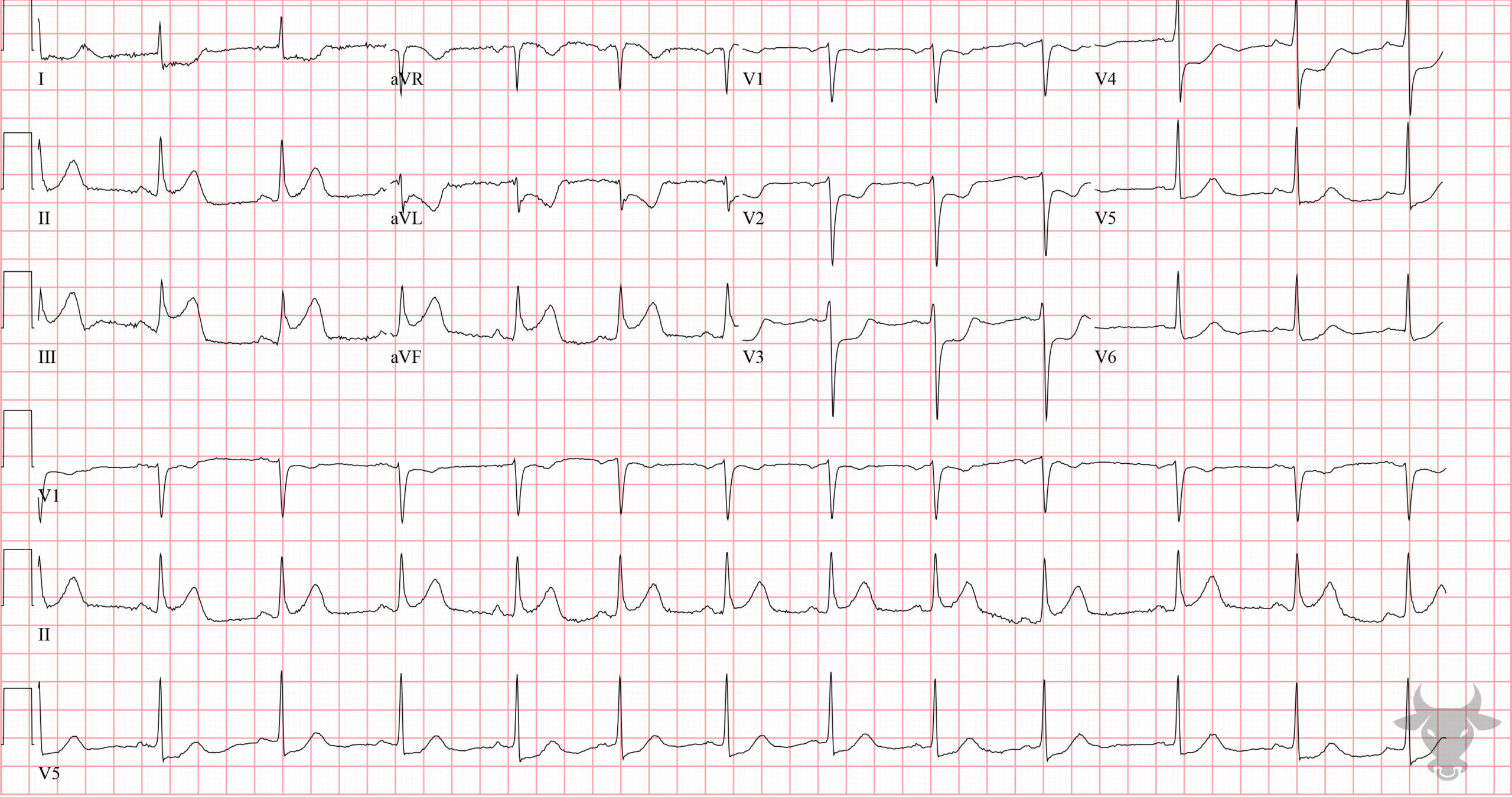 ECG Showing ST-elevation Myocardial Infarction