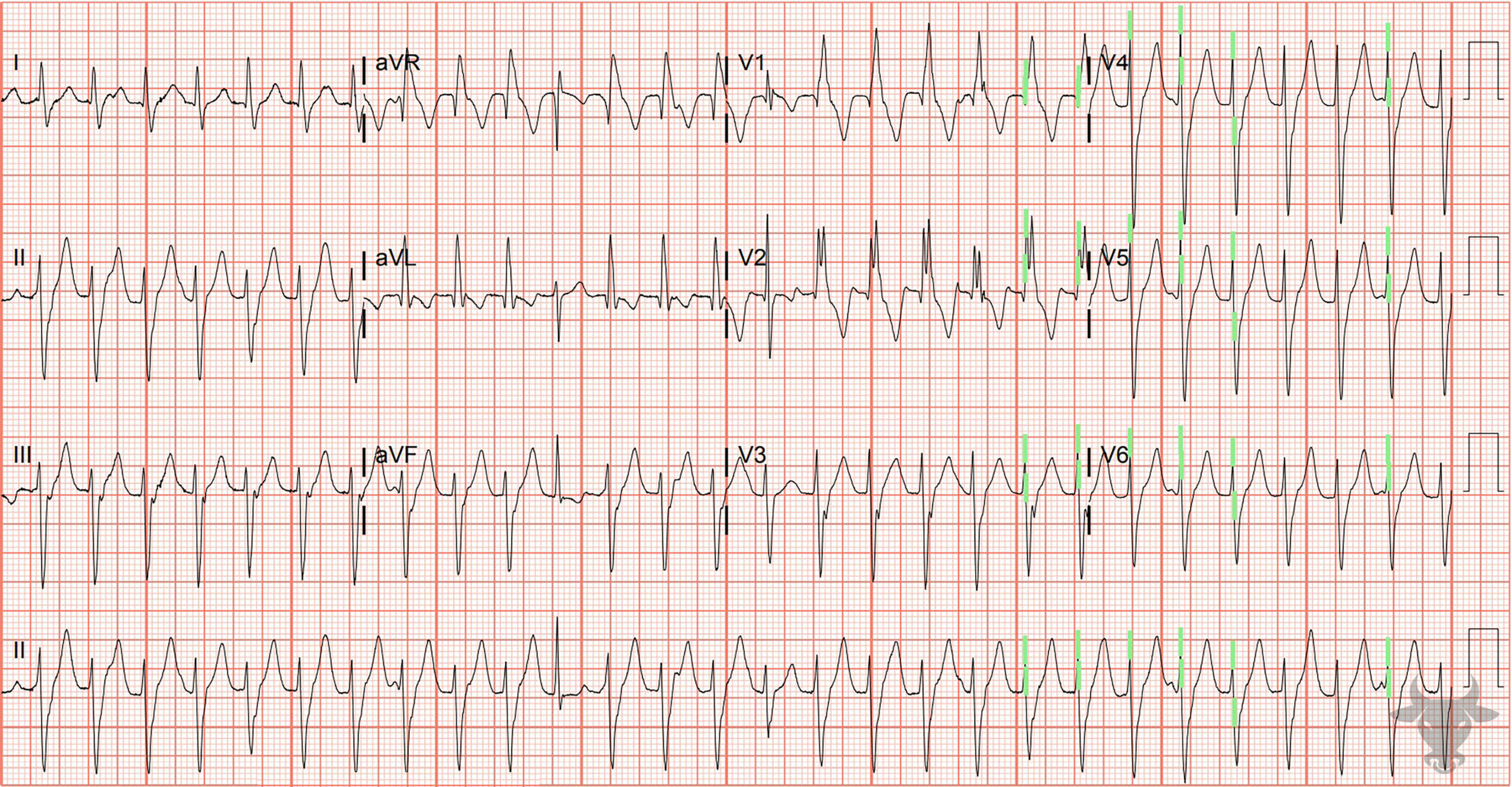 ECG Showing Ventricular Tachycardia