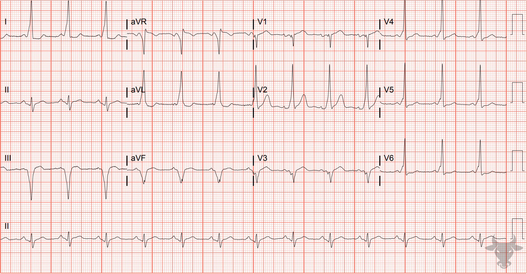 ECG Showing Ventricular Pre-excitation