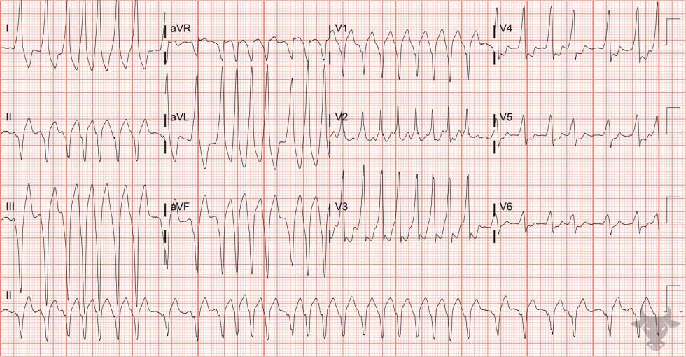 Atrial Fibrillation with WPW | ECG Stampede