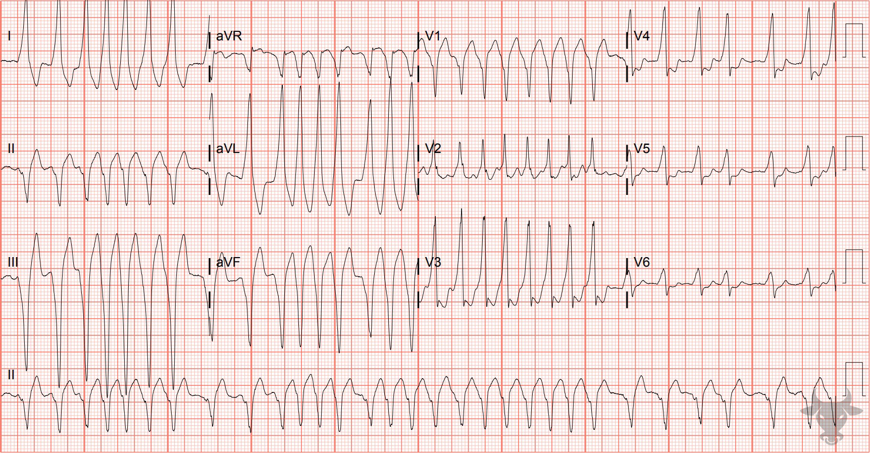 ECG Showing Atrial Fibrillation with WPW