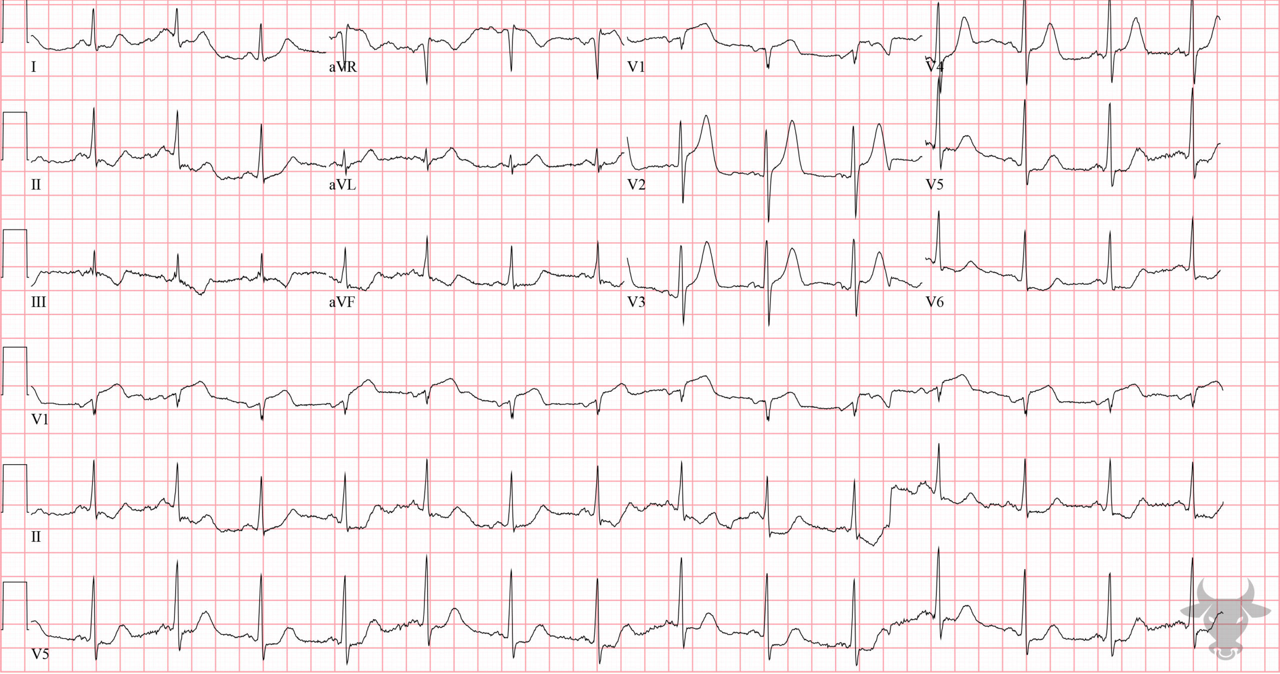 ECG Showing Hyperacute T waves