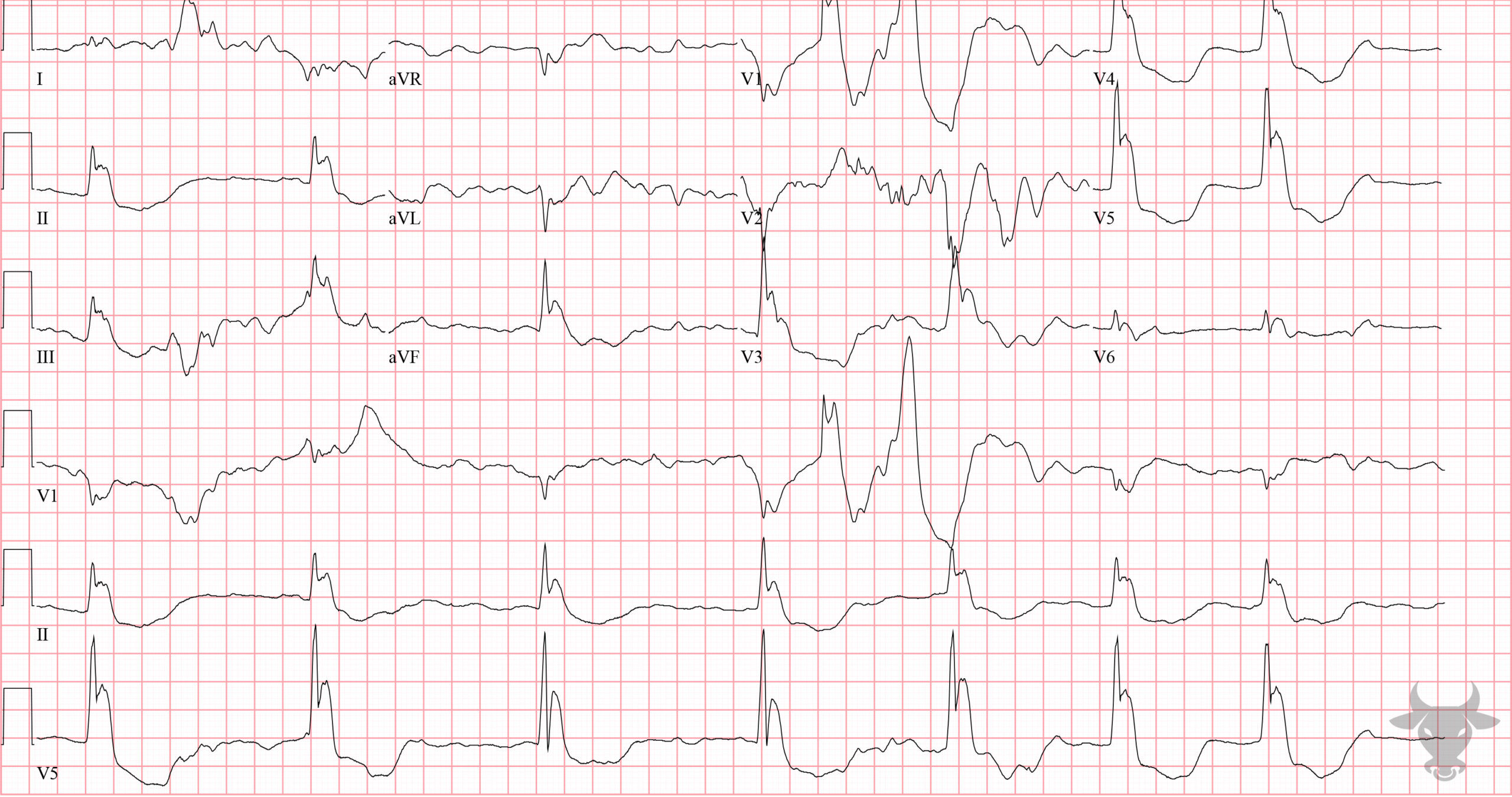 ECG Showing Hypothermia