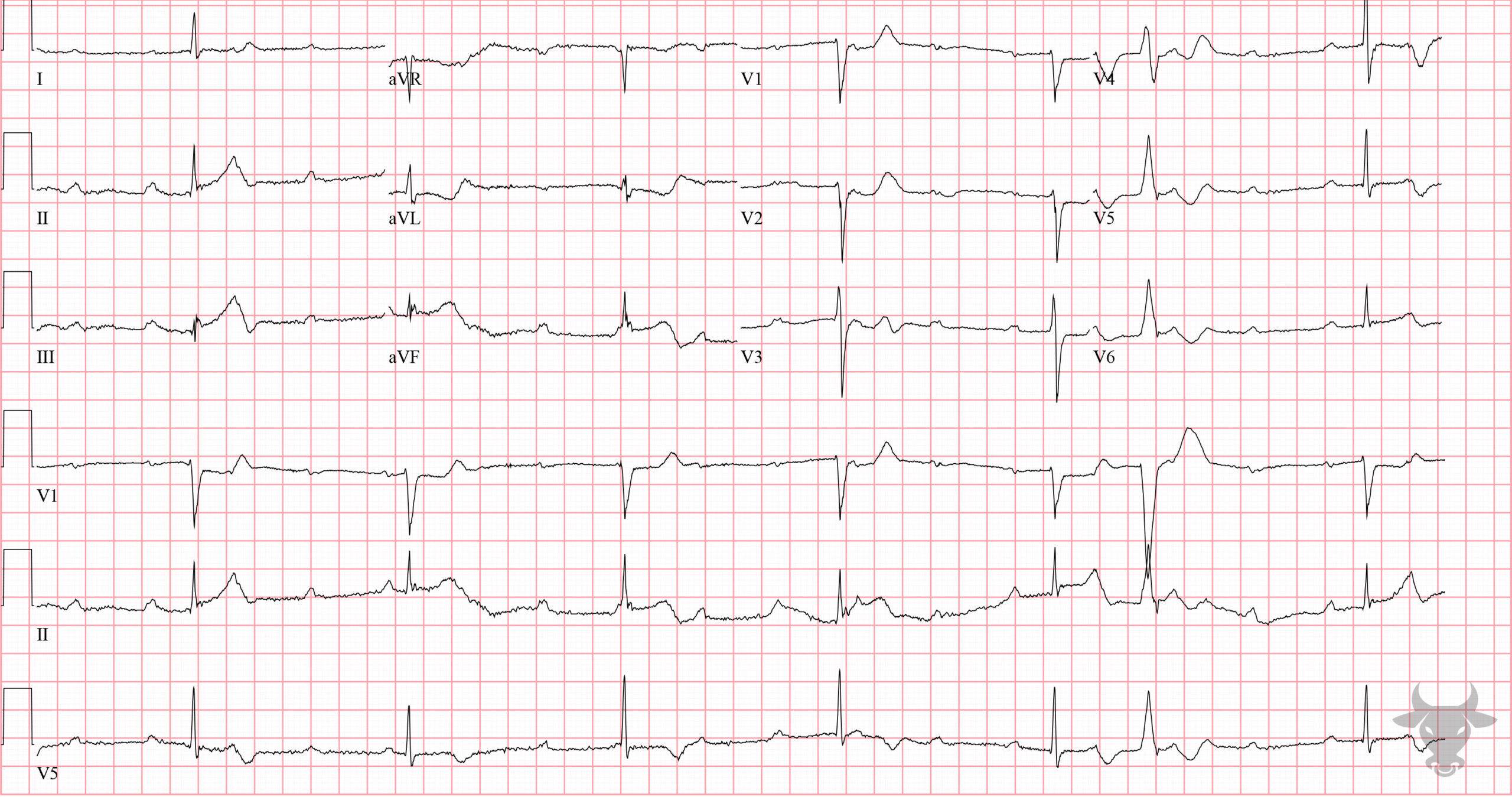 ECG Showing ST-elevation Myocardial Infarction