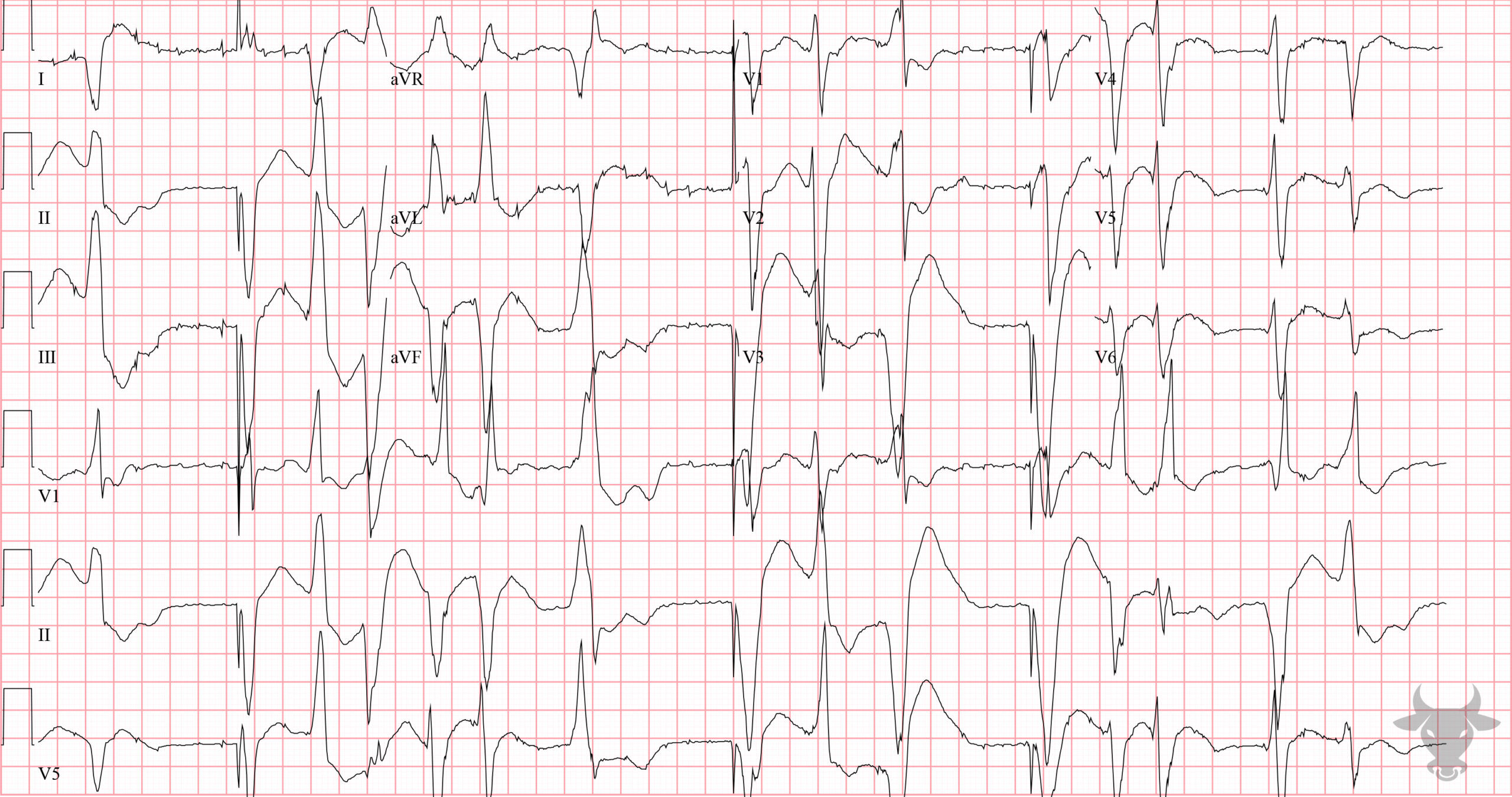 ECG Showing Hypokalemia