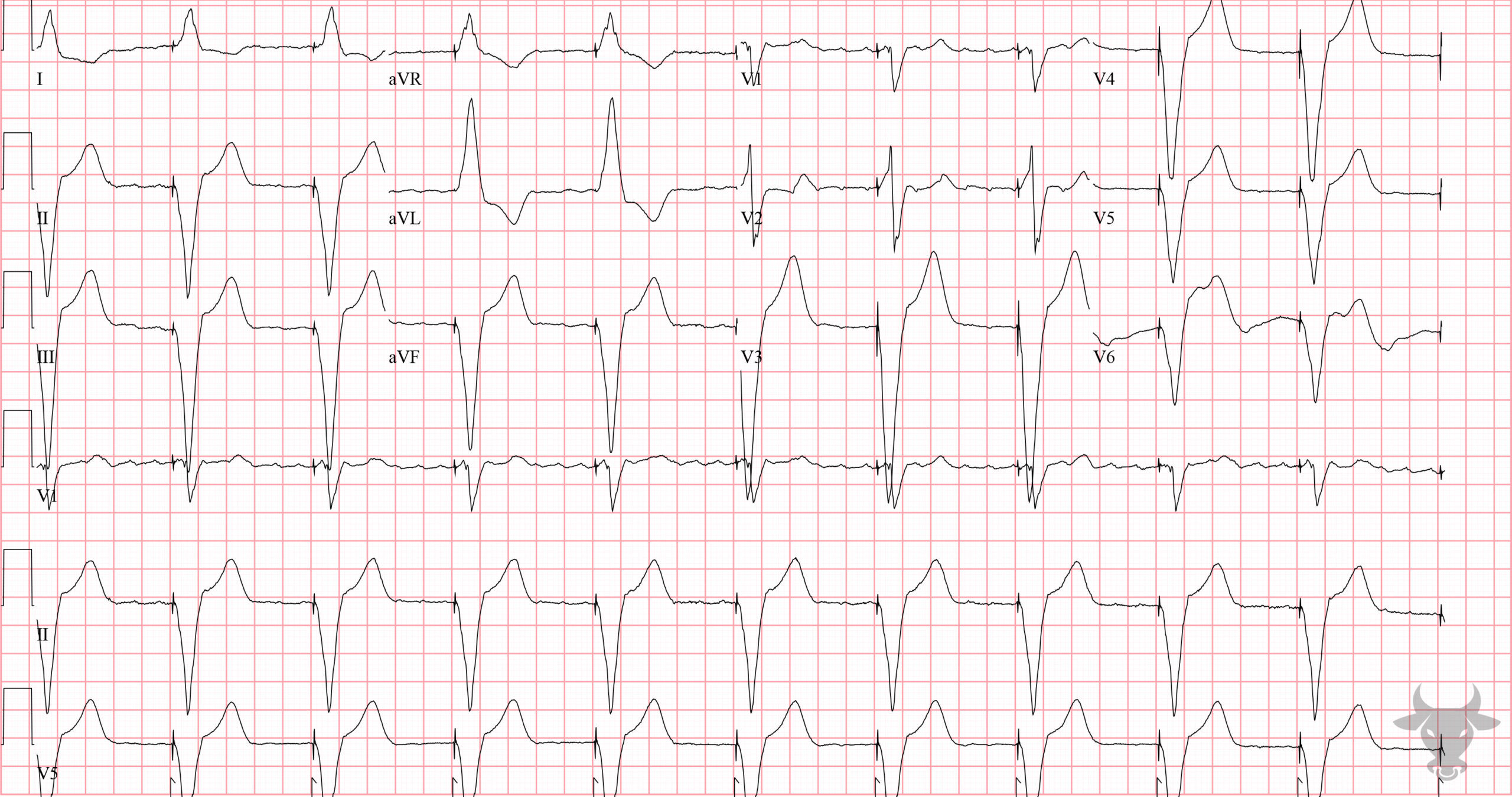 ECG Showing Paced Rhythm