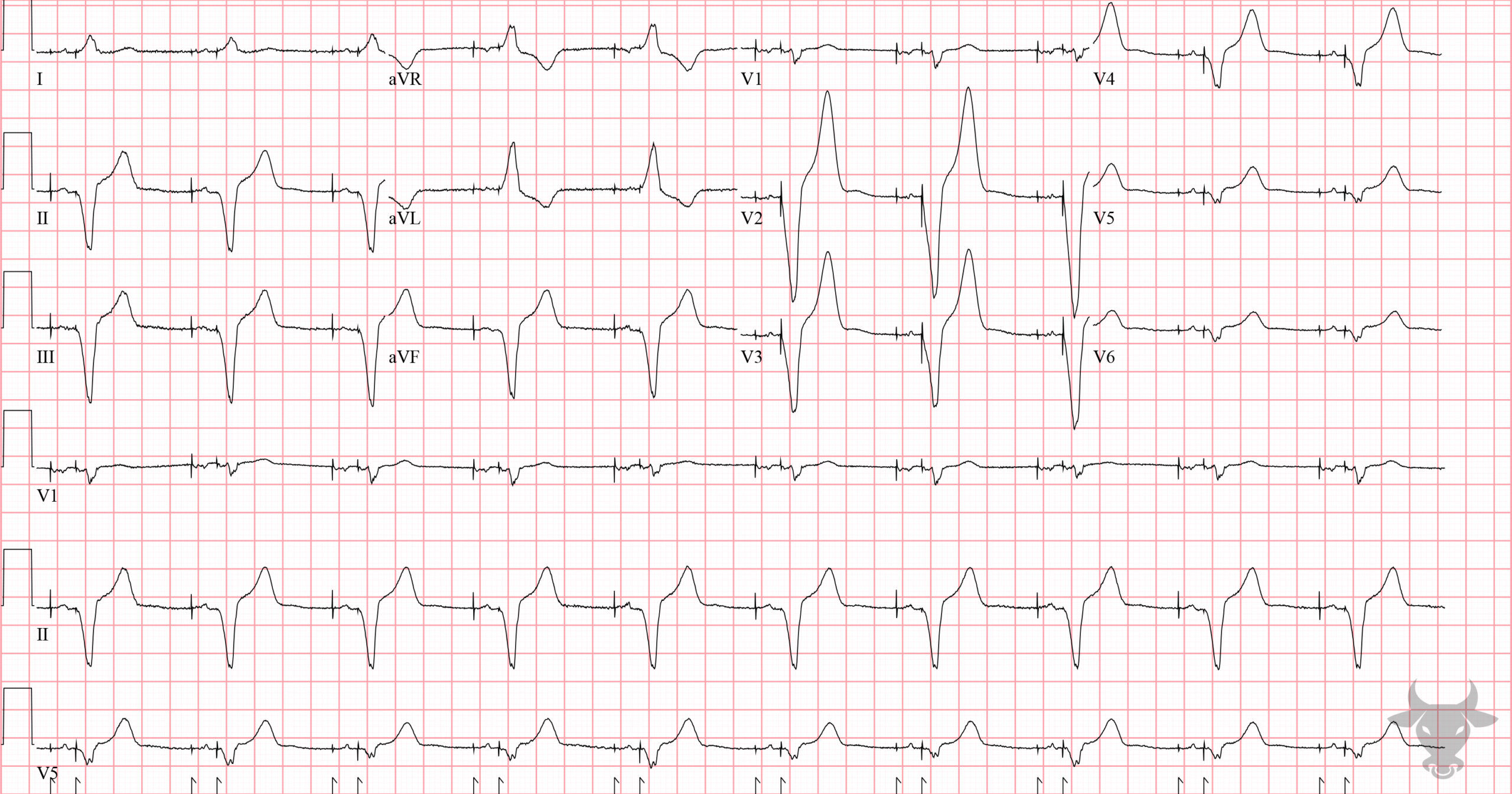 ECG Showing Paced Rhythm