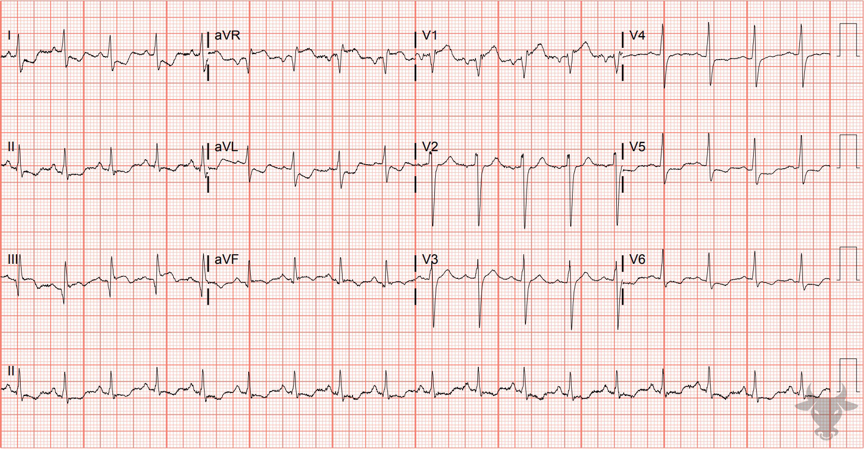 ECG Showing ST-elevation Myocardial Infarction