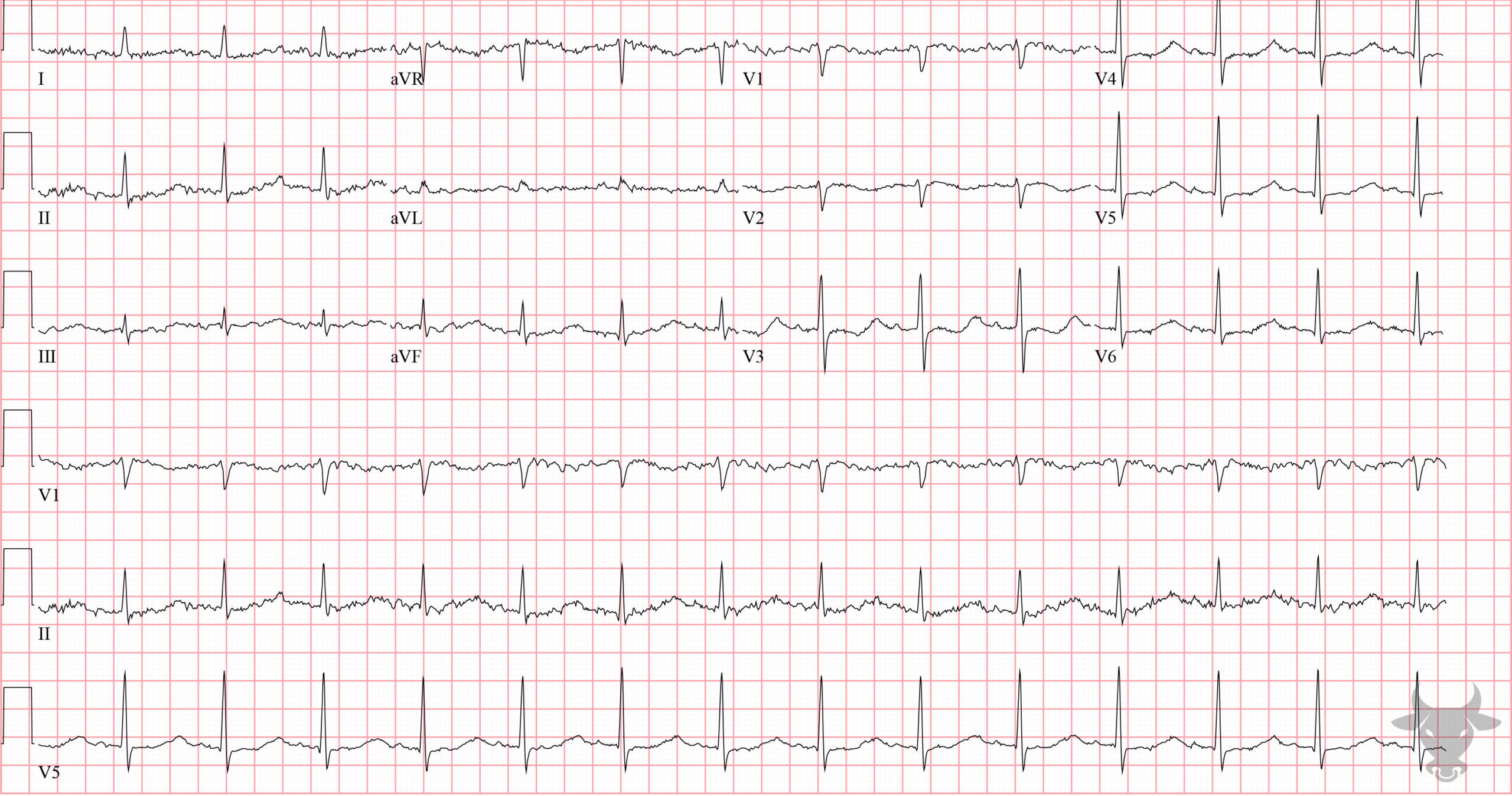 ECG Showing Hypokalemia