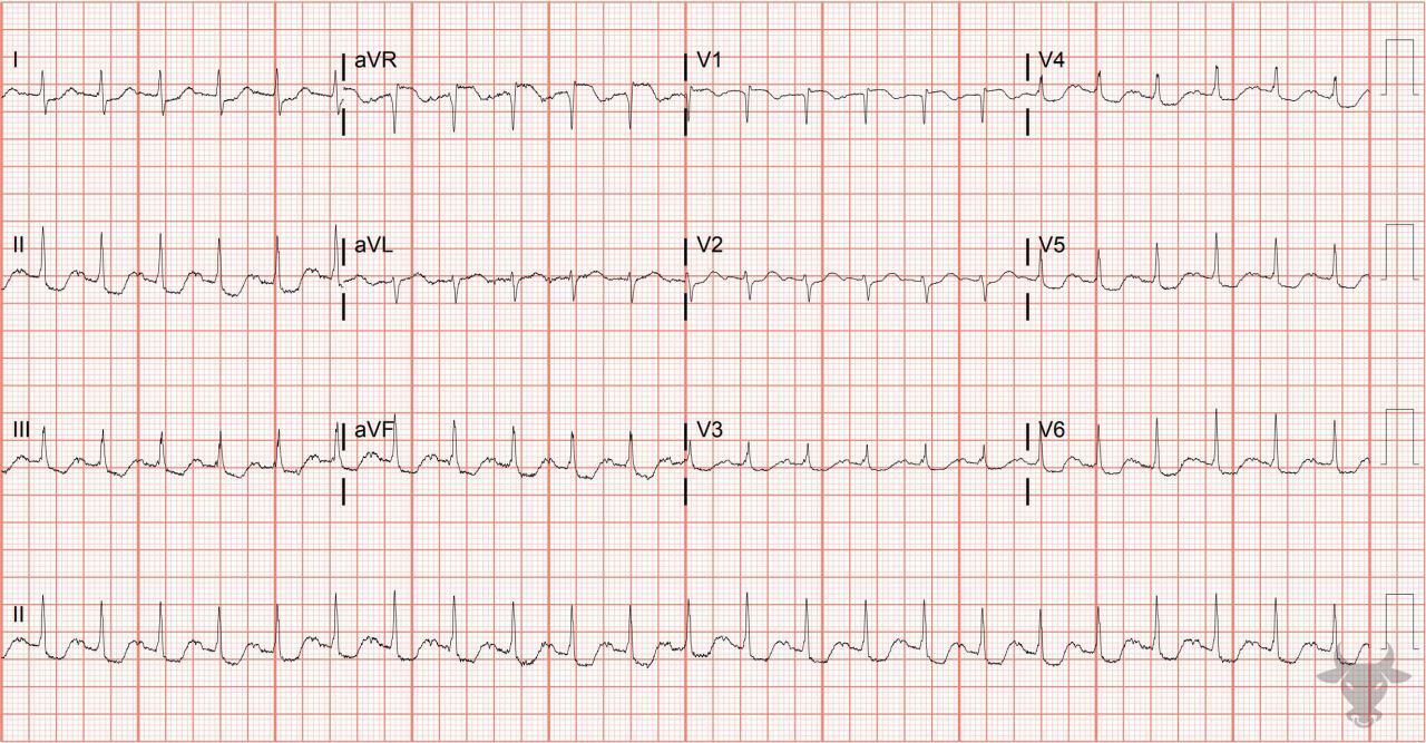 Pulmonary embolism ecg stampede