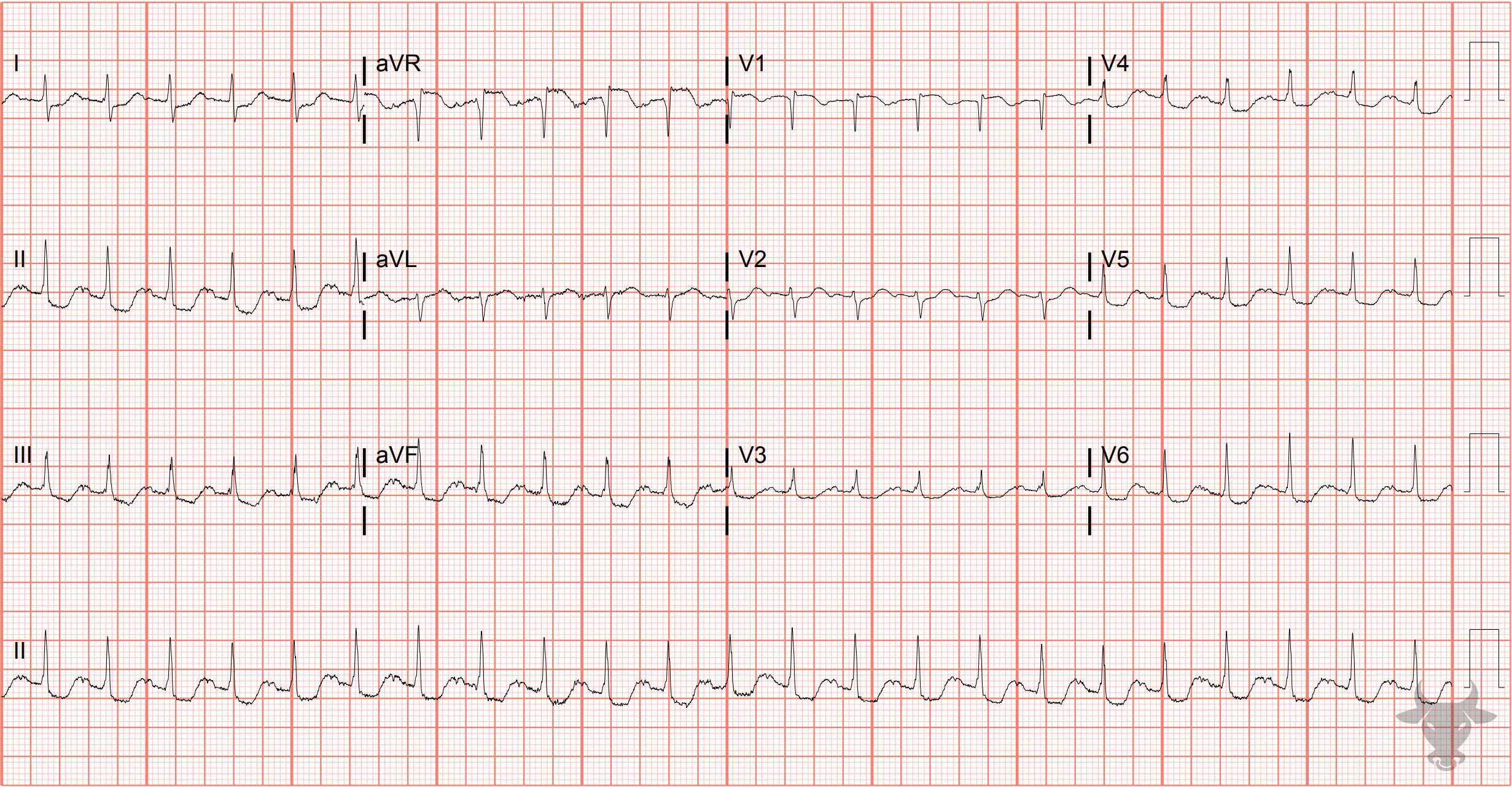 ECG Showing Global Subendocardial Ischemia