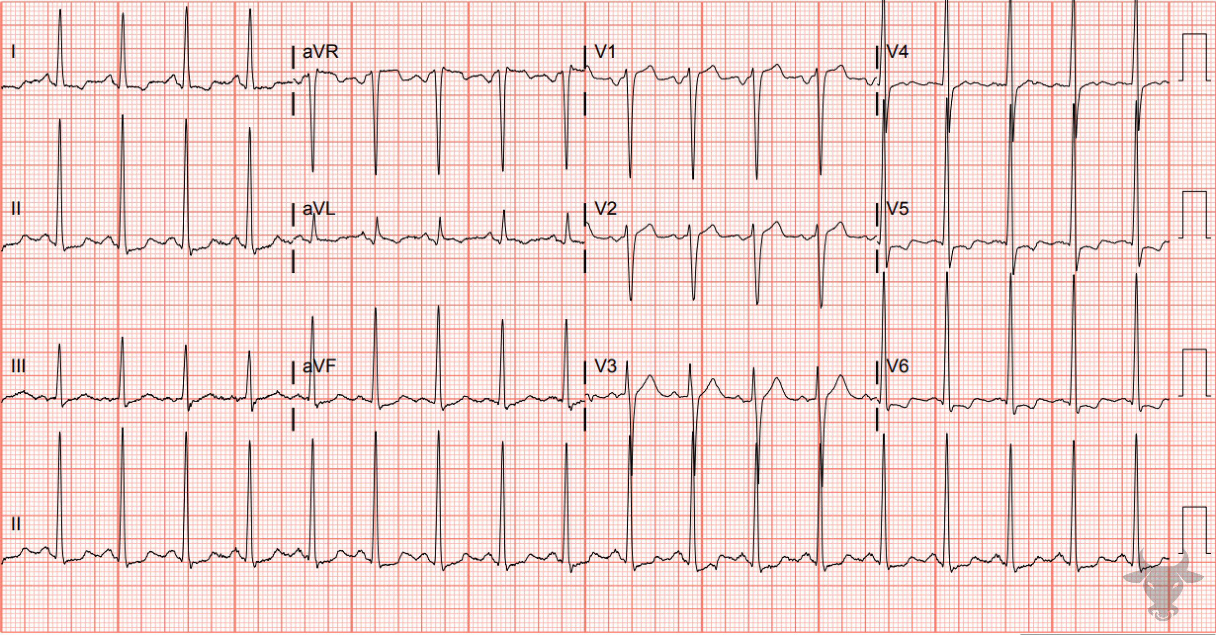 ECG Showing Left Ventricular Hypertrophy