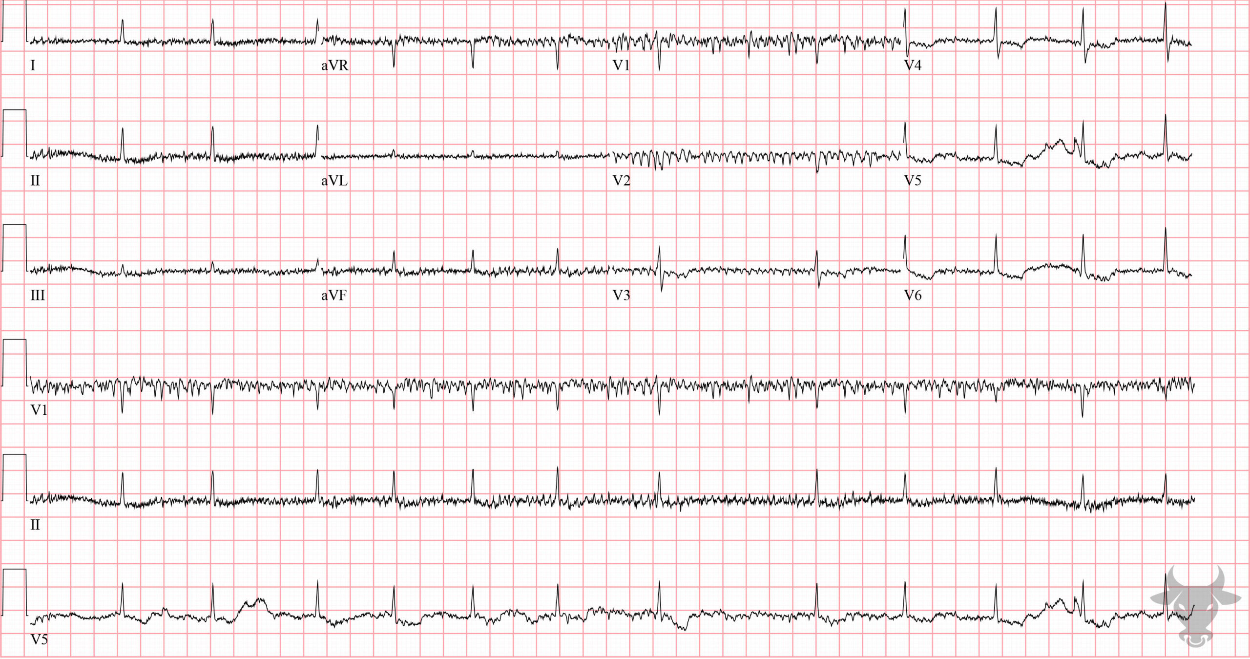 ECG Showing the Digoxin Effect