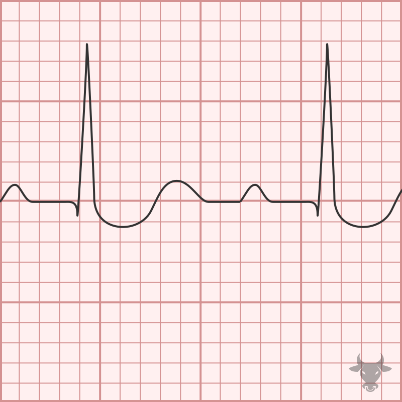 Digoxin Toxicity