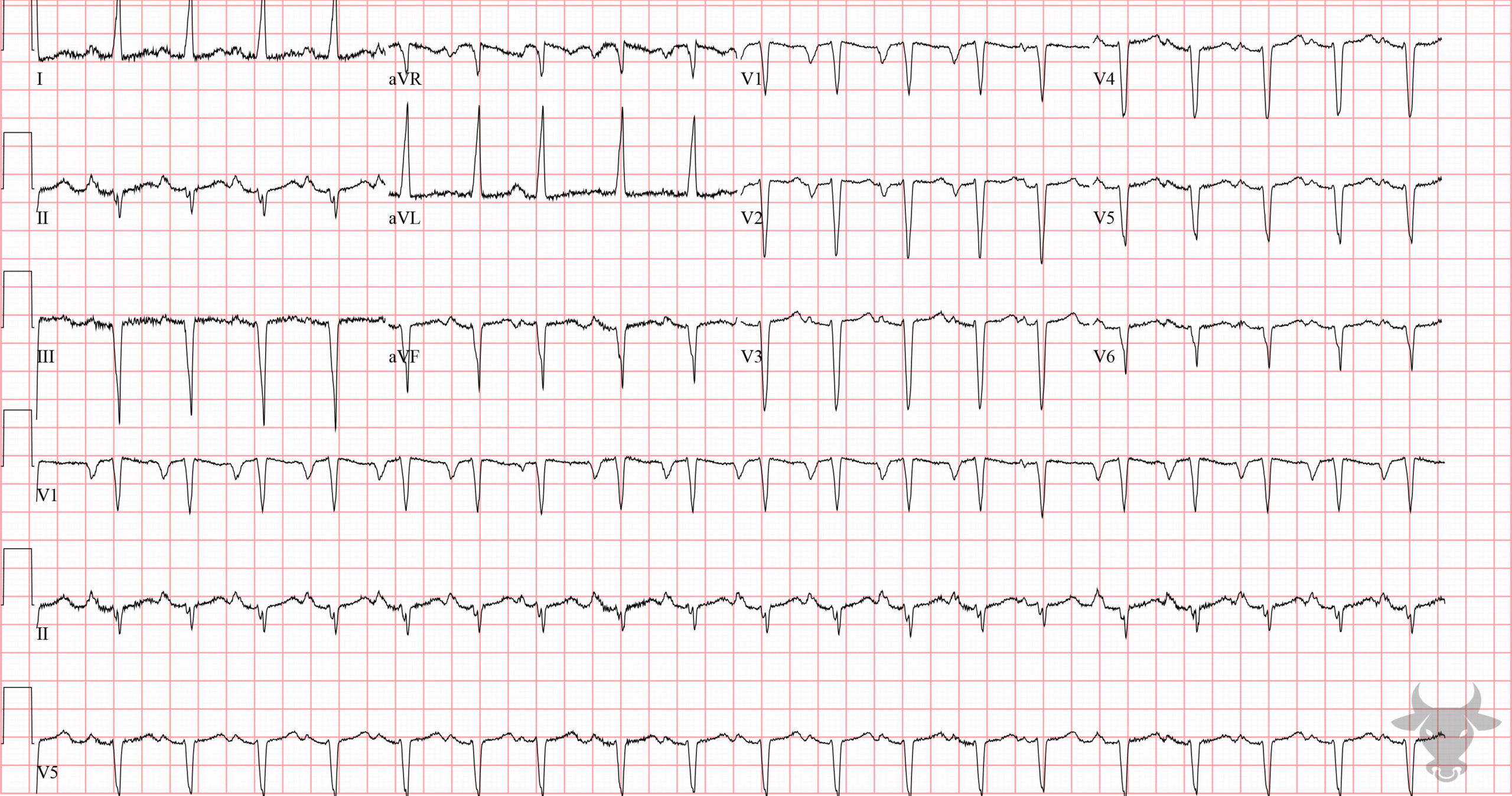 ECG Showing Left Ventricular Hypertrophy