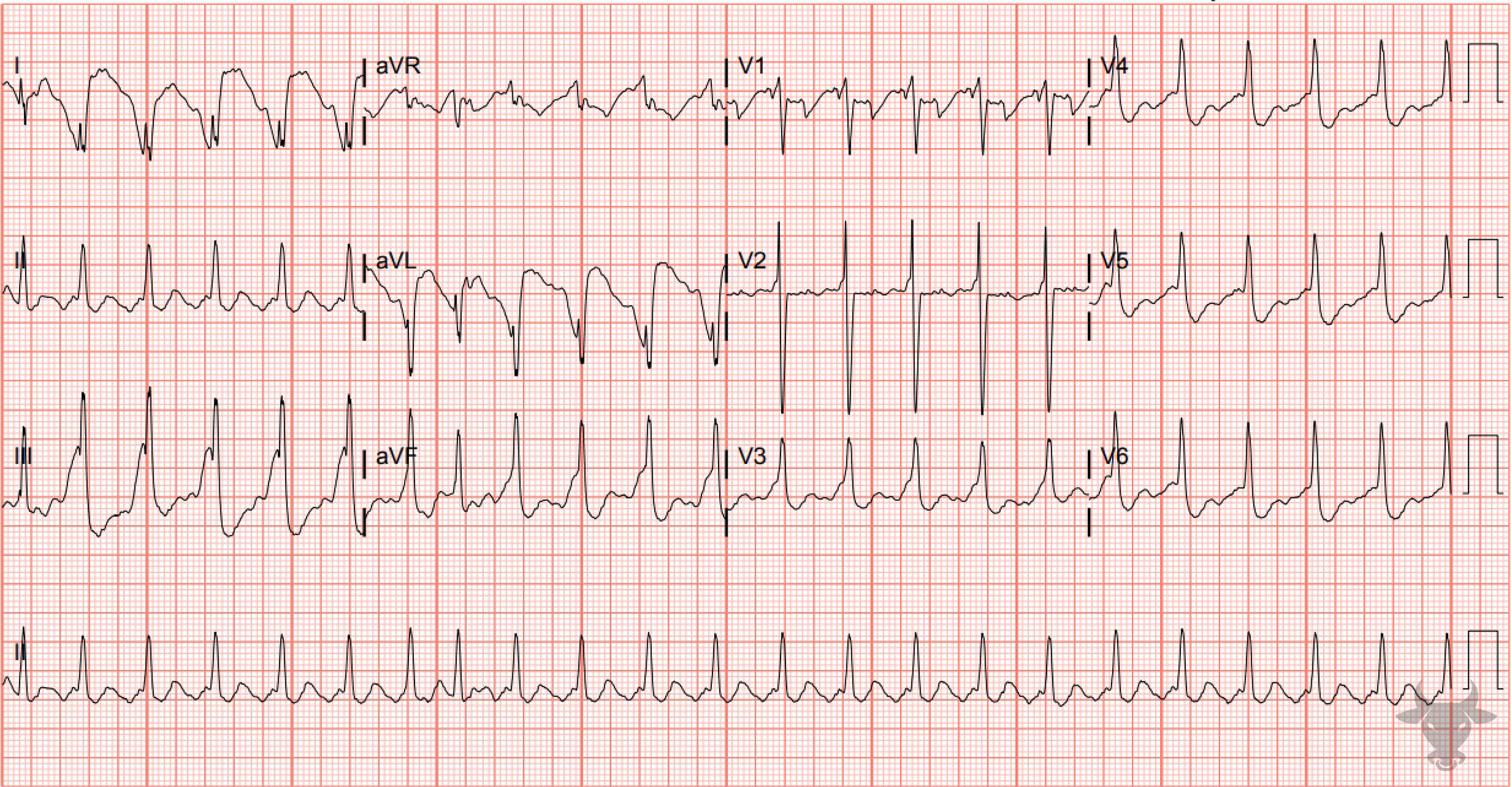 ECG Showing Sodium Channel Toxicity