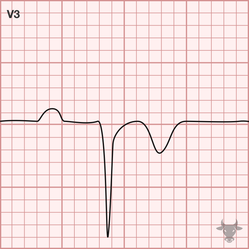 Poor R wave Progression ECG Stampede