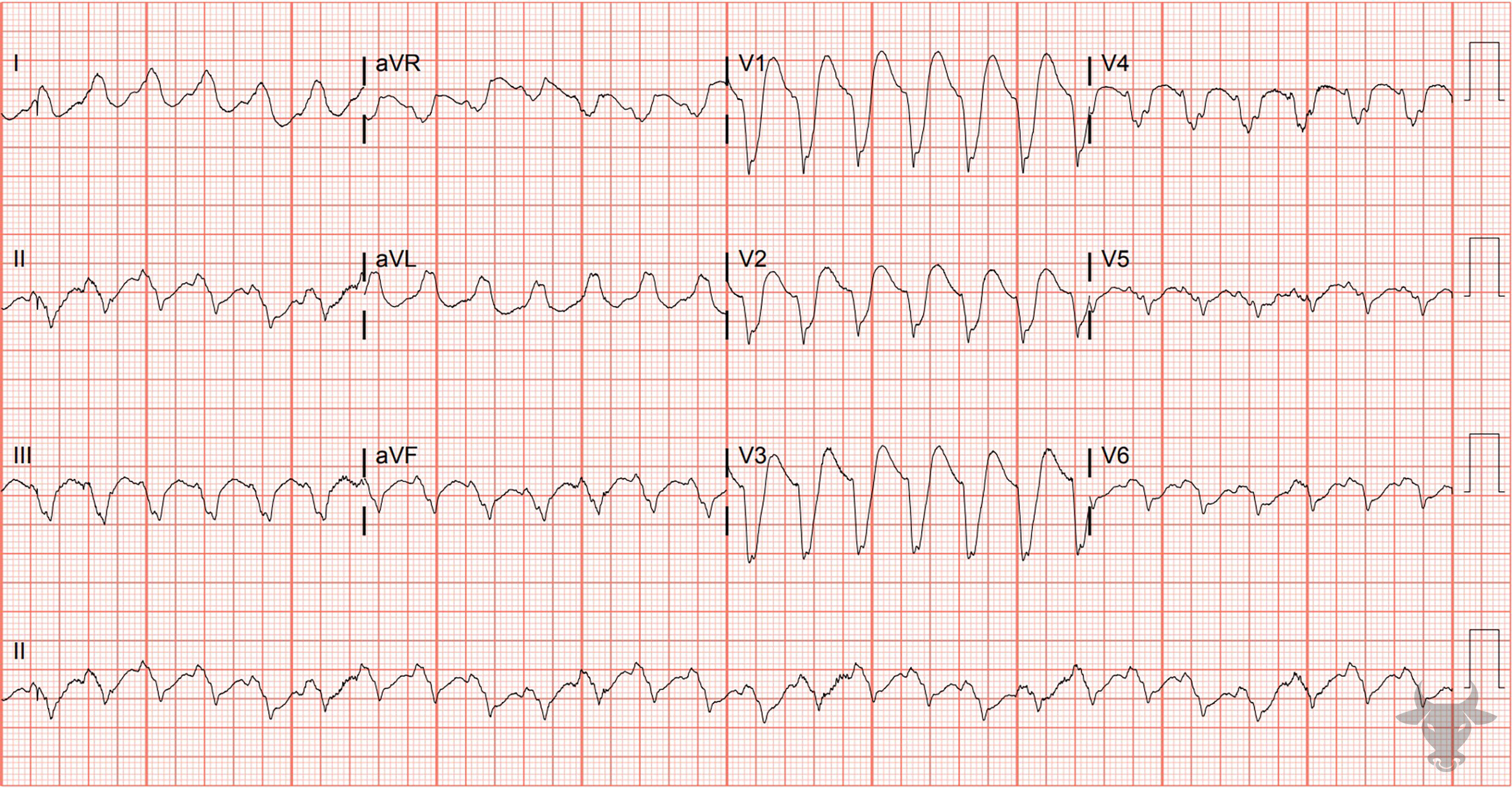 ECG Showing Ventricular Tachycardia