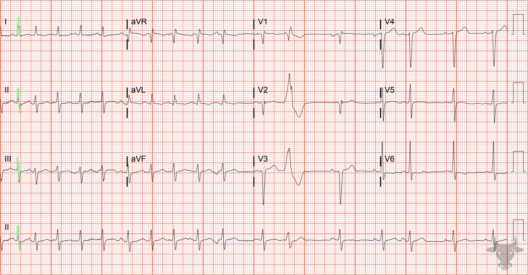 ECG Showing Multifocal Atrial Tachycardia