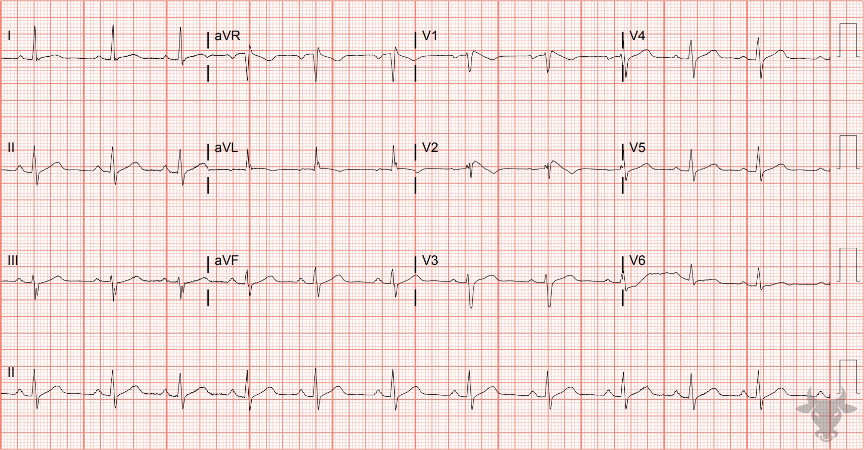 ECG Showing Brugada Syndrome