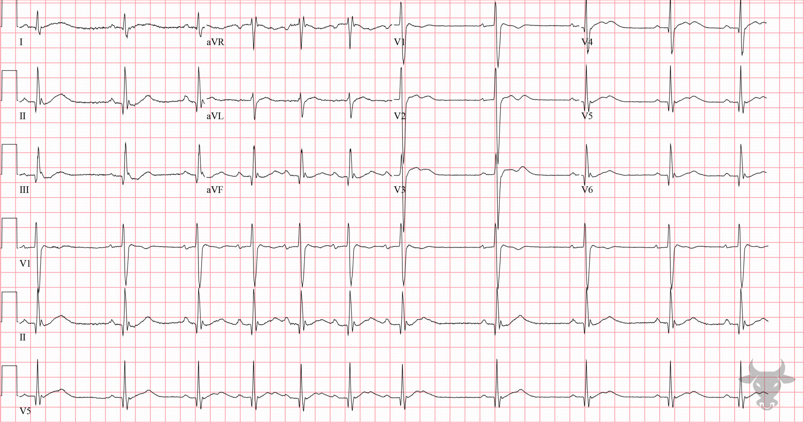 ECG Showing Hypokalemia