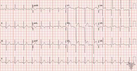 Left Ventricular Aneurysm | ECG Stampede