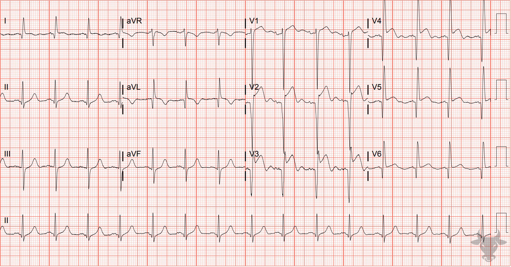 ECG Showing Left Ventricular Aneurysm