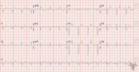 Hyperkalemia | ECG Stampede