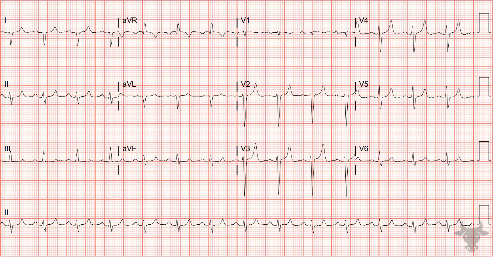 ECG Showing Hyperkalemia