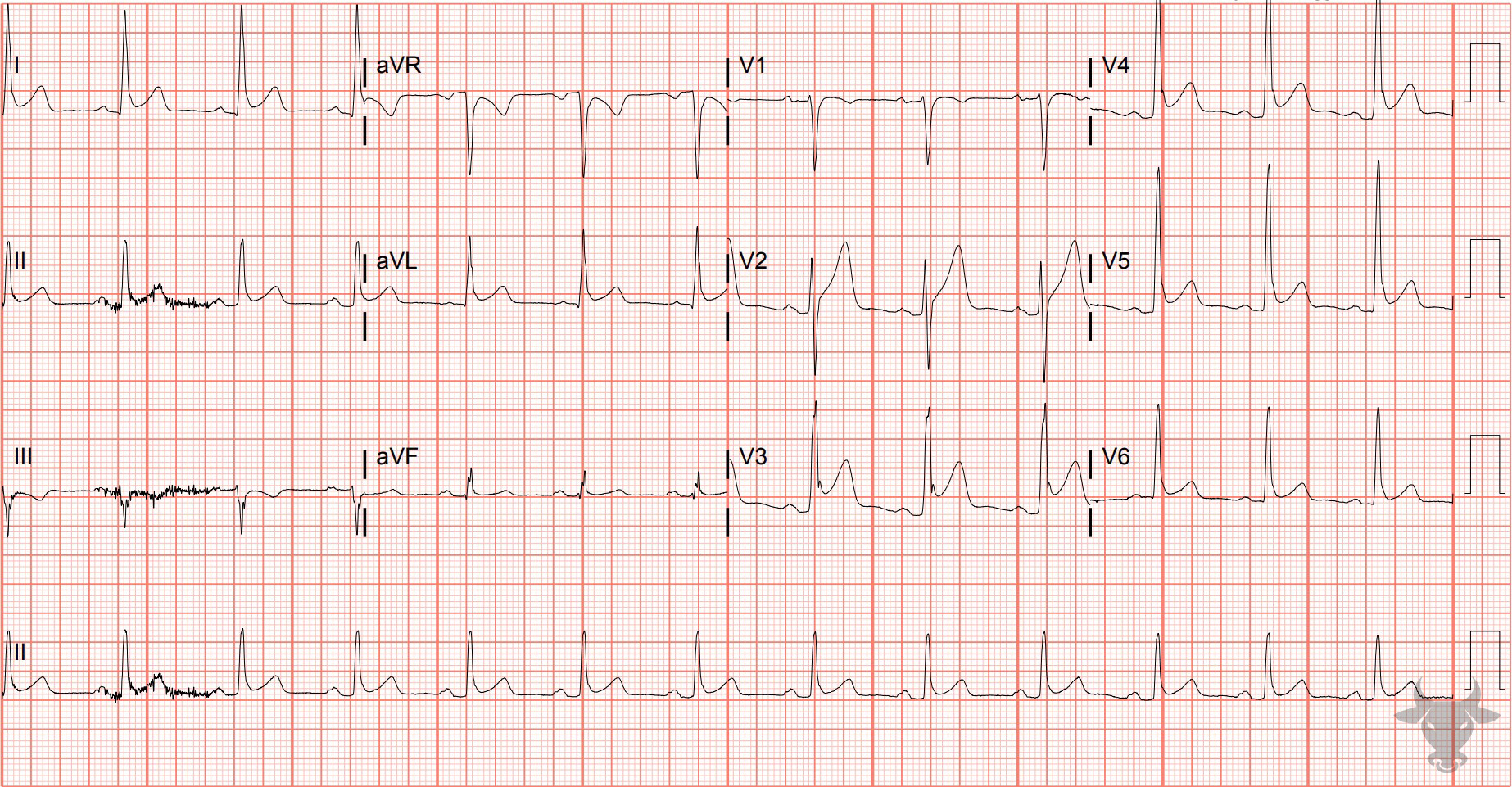 ECG Showing Early Repolarization