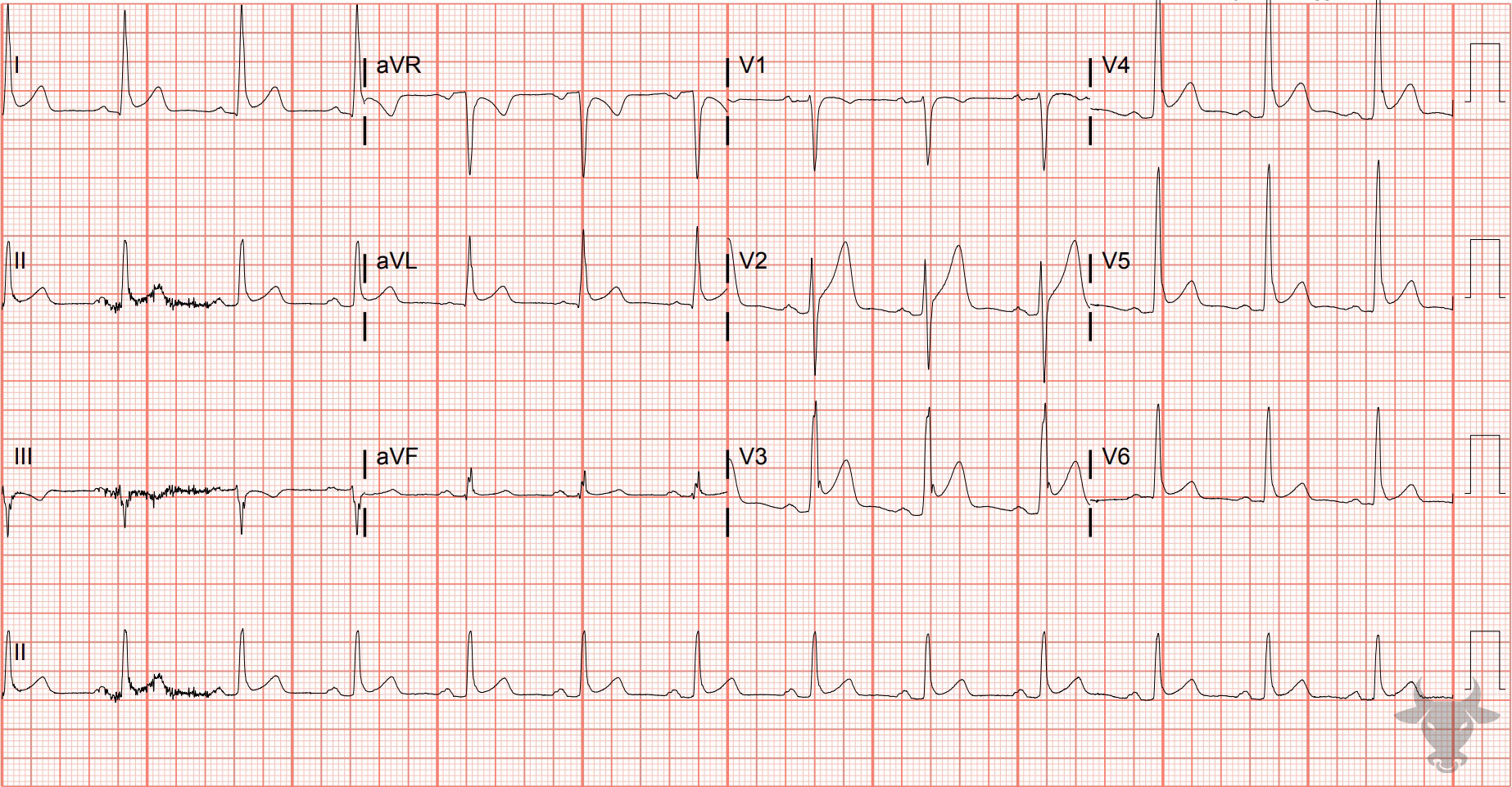 ECG Showing Early Repolarization