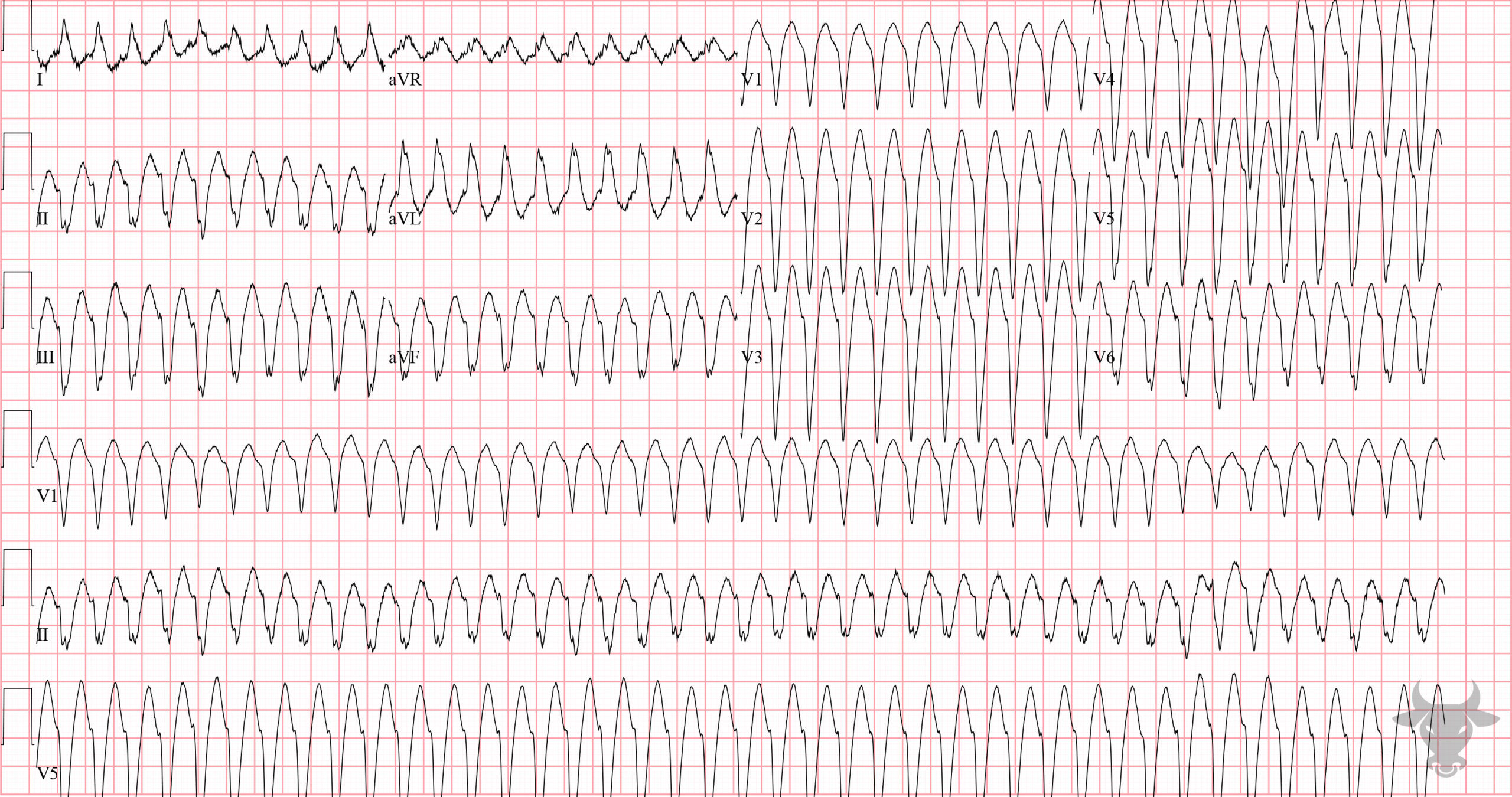 ECG Showing Ventricular Tachycardia