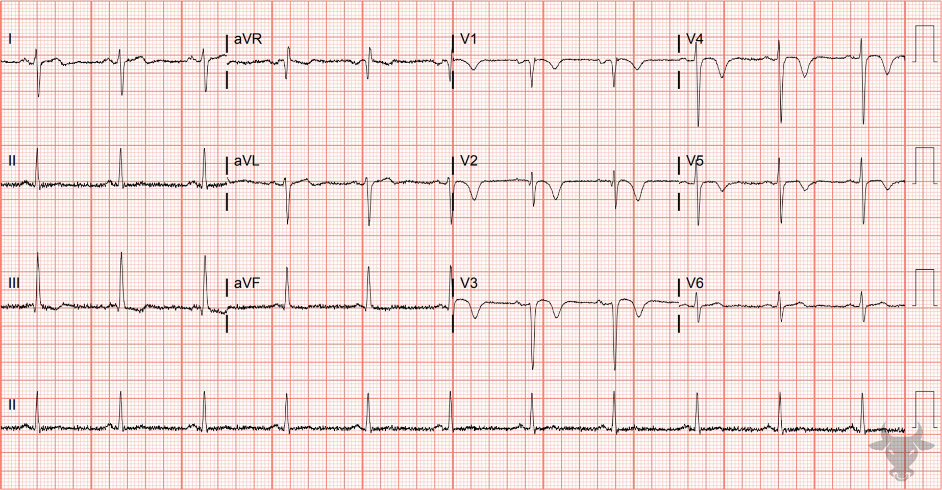 ECG Showing Wellens Syndrome