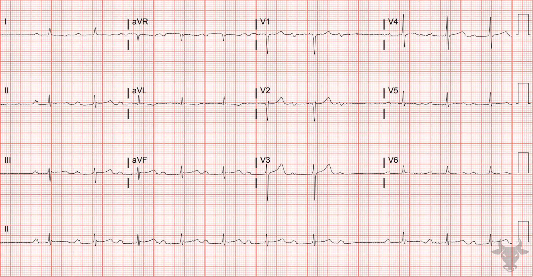 ECG Showing Second Degree Atrioventricular Block - Mobitz I