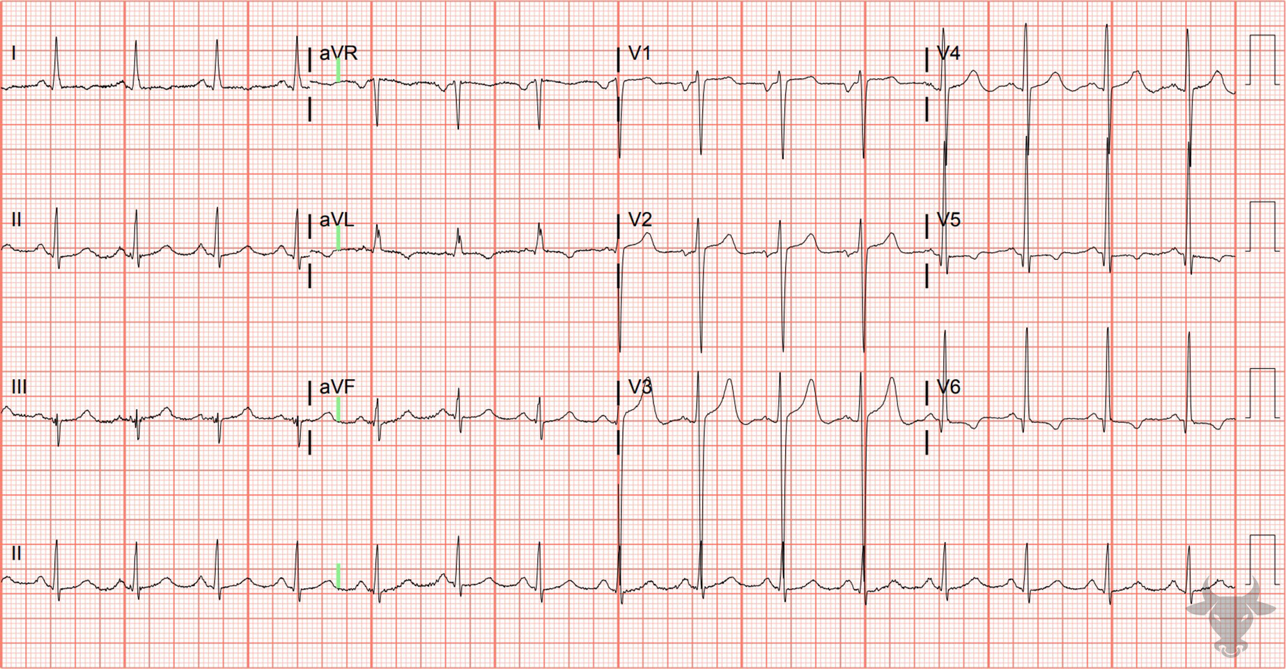 ECG Showing Left Ventricular Hypertrophy and Left Atrial Enlargement