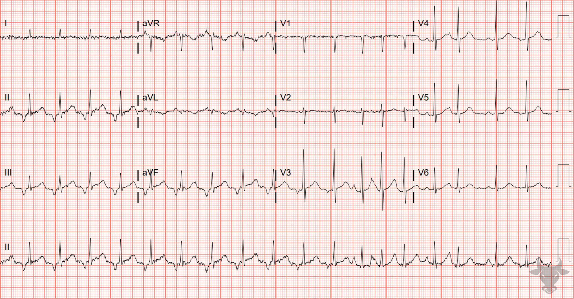 ECG Showing Multifocal Atrial Tachycardia