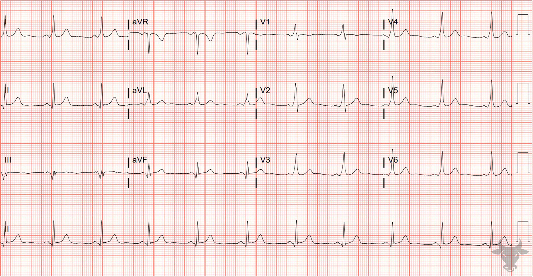 ECG Showing Ventricular Pre-excitation